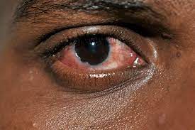 Read more about the article Conjunctivitis cases reported in Chipata, Lumezi