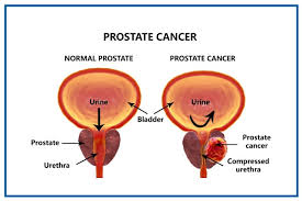 Read more about the article Zimba sees 10 prostate cases weekly